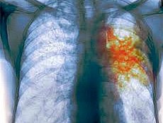 туберкулез туберкулез