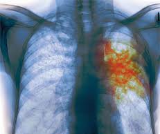 Тубдиспансер проведет акцию и выдаст направления туберкулез